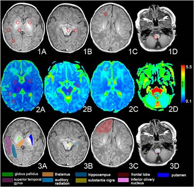 Magnetic Resonance Image of Neonatal Acute Bilirubin Encephalopathy: A Diffusion Kurtosis Imaging Study